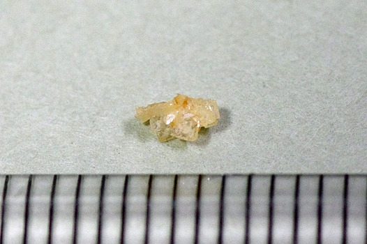 尿管結石.jpg